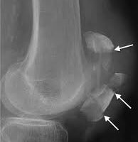 Broken knee