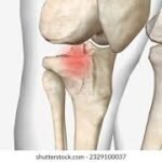 Fractured knee