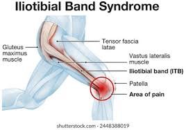 Iliotibial band tear