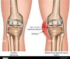 Medial ligament