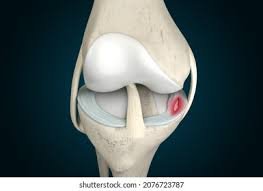 Meniscus tear