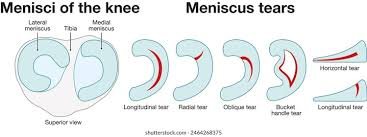 Meniscus tear