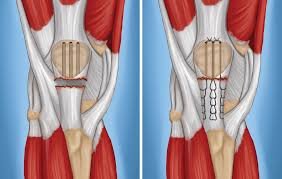 Patellar tendon injury