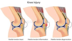 Patellar tendon injury