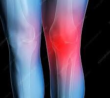 Twisted knee